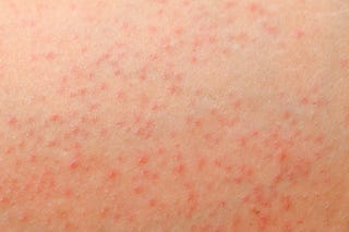 13 Common Causes For Itchy Butt Rashes And Bumps According To Mds