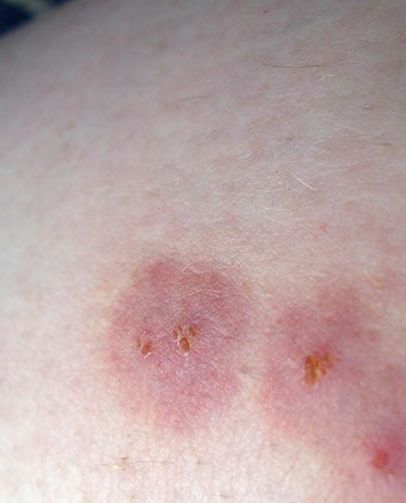 11 Common Bug Bite Pictures How To Id Insect Bites And Stings