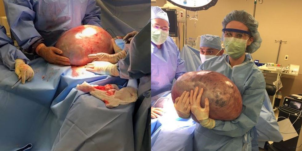 Alabama Woman Has 50-Pound Ovarian Cyst Removed