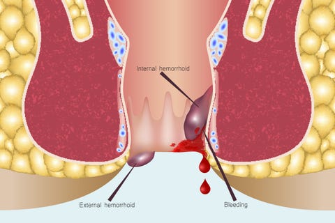 inside anus itching Deep