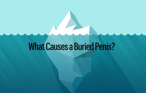 Åben Pinpoint global What Causes a Buried Penis? How to Treat a Hidden Penis