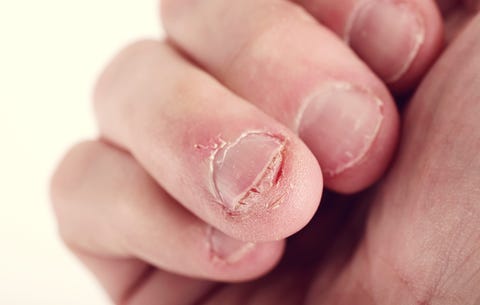 Nail Biting Hacks This Is The Only Way To Kick Habit Men S Nail Biting Hacks