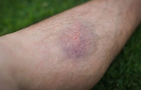 Elder Blood Bruise Under Skin