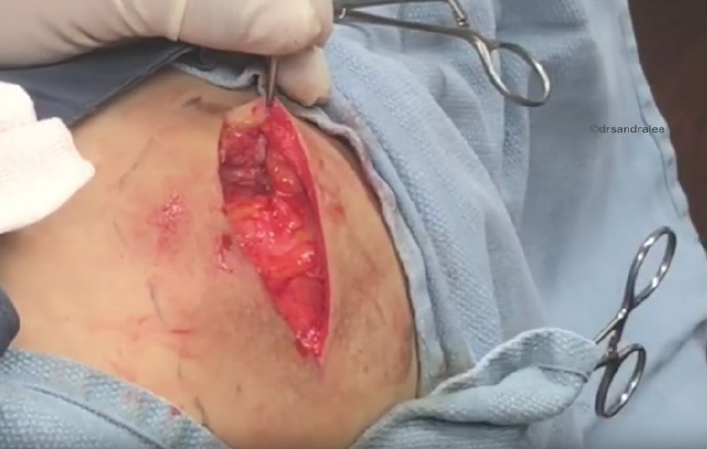 You Will Gag When You See This 50-Year-Old Cyst Being 