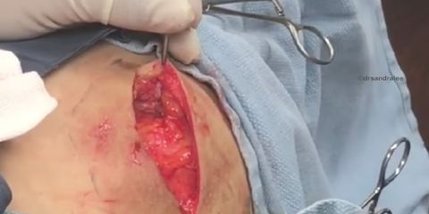 50-year-old cyst being popped