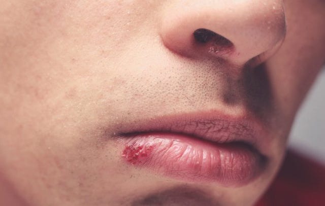 how-to-identify-a-herpes-cold-sore-vs-pimple-expert-advice-allure