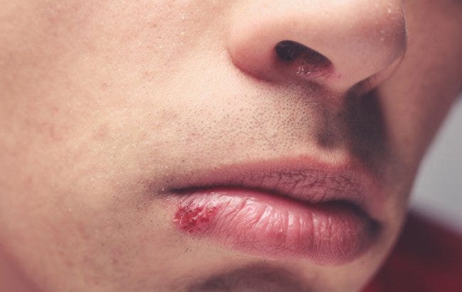 how-to-detect-prevent-and-treat-herpes-men-s-health