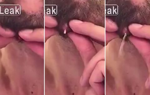 480px x 305px - Man Pops a Giant Pimple On His Chin and Almost Vomits ...