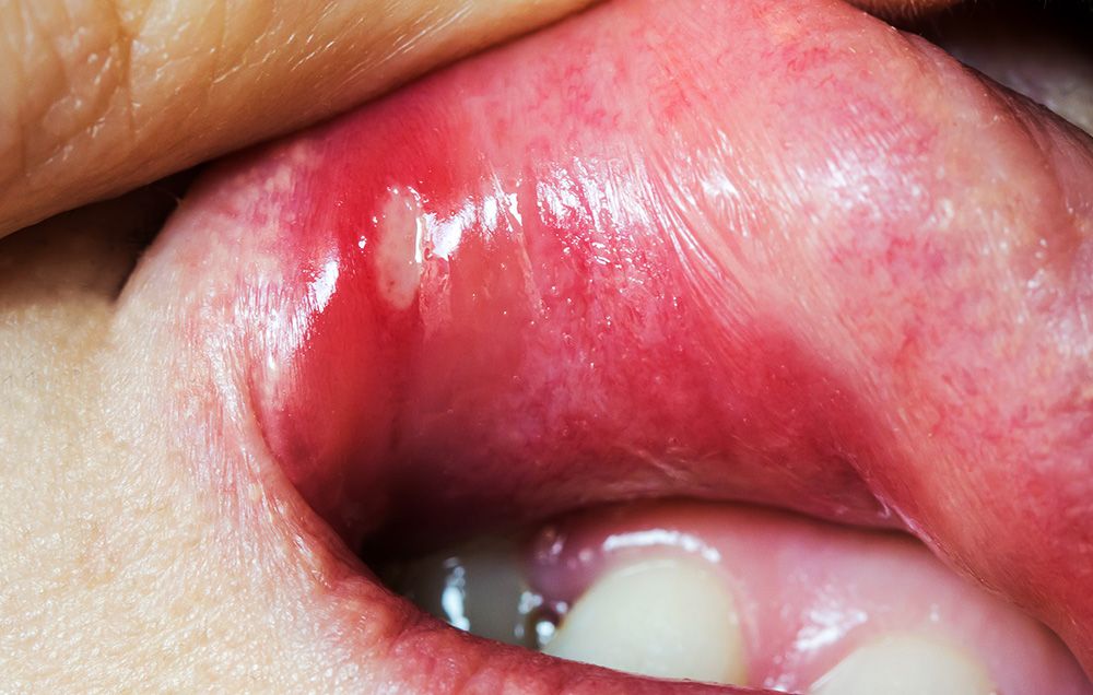 How do you treat a canker sore on your tongue Home Remedies For Canker Sores Men S Health