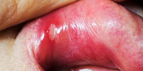 cure canker sores