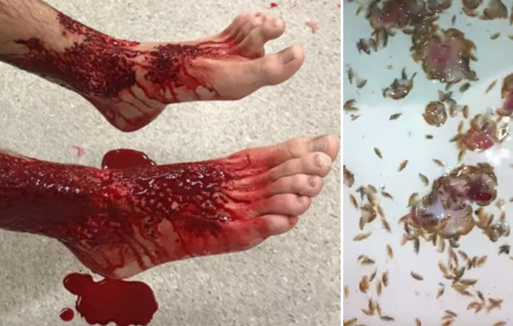 Flesh-Eating Sea Bugs Eat Australian Teen s Legs Men s 