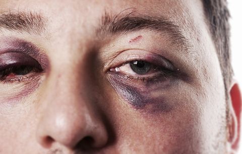 Image result for bruise on eyes