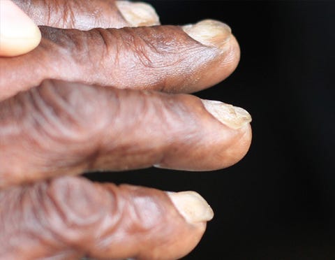What Your Nails Say About Your Health