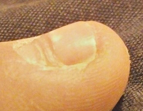 Black Spot On Toenail Near Cuticle - Nail Ftempo