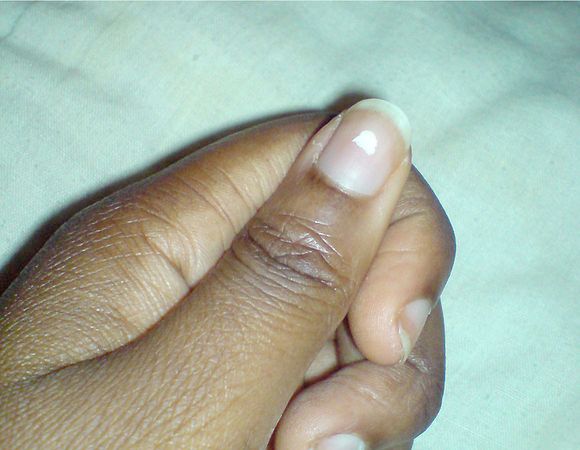 What Your Nails Say About Your Health