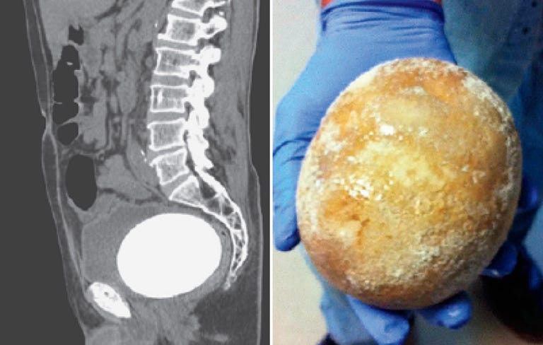 Large Bladder Stone Causes Peeing Problems | Men’s Health