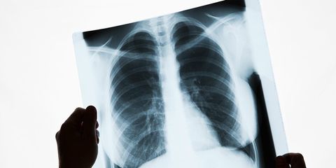 This Is Why Men Need to Be Screened For Lung Cancer More Than Women