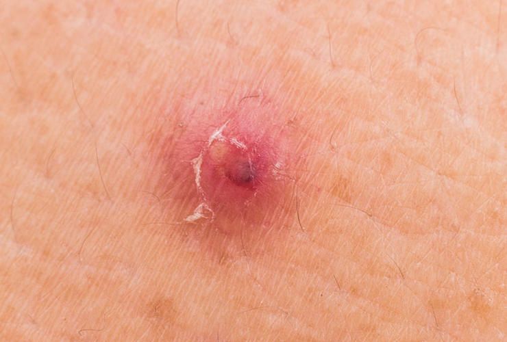 Why You Should Never Pop Zits Ingrown Hairs And Other Bumps Men S Health