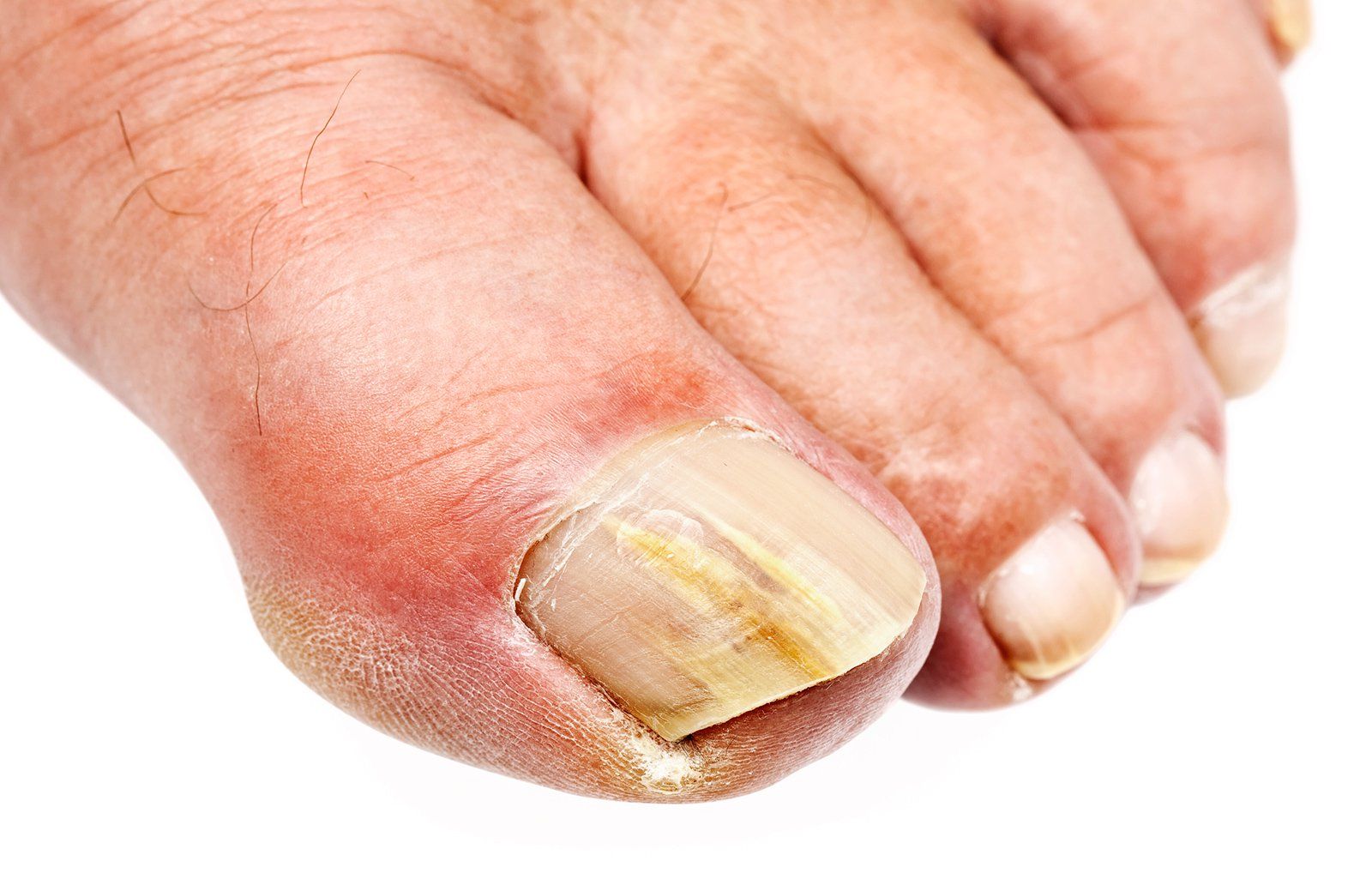 White Discoloration On Toenails After Nail Polish Nail Ftempo