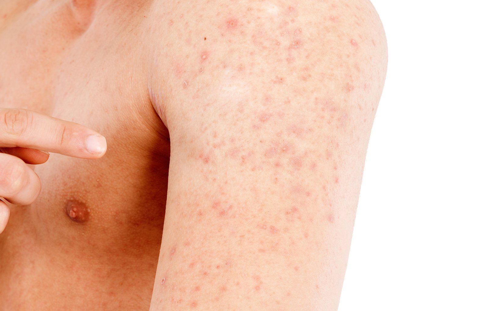 Does Viral Rash Get Worse With Heat at Gloria Bacon blog