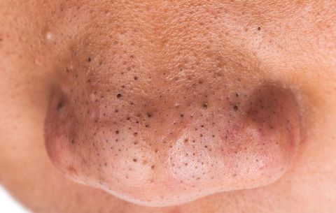 How to Get Rid of Blackheads on Your Nose | Men’s Health