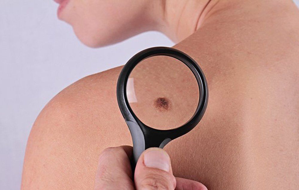 This Is What Skin Cancer Looks Like Men S Health