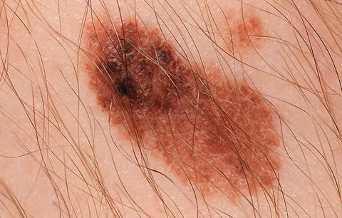 This Is What Skin Cancer Looks Like Men S Health
