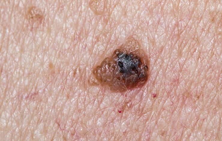 This Is What Skin Cancer Looks Like Men S Health