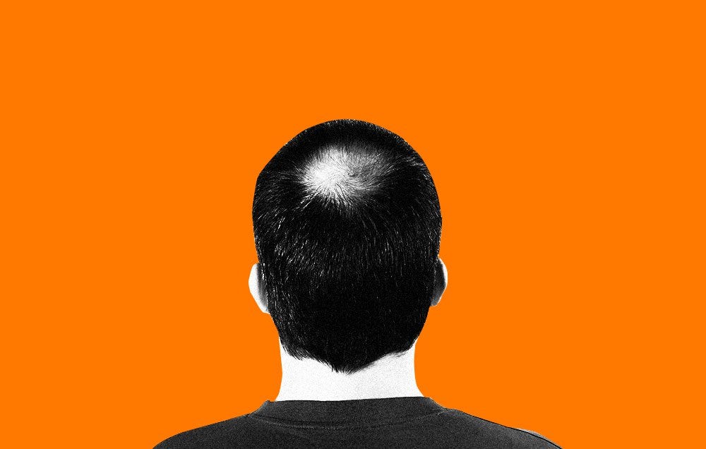 Dihydrotestosterone Dht Can Cause Baldness But What Is It Men S Health