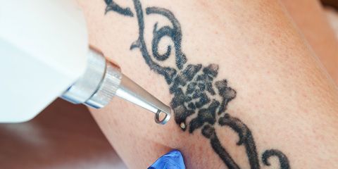 what to know tattoo removal 