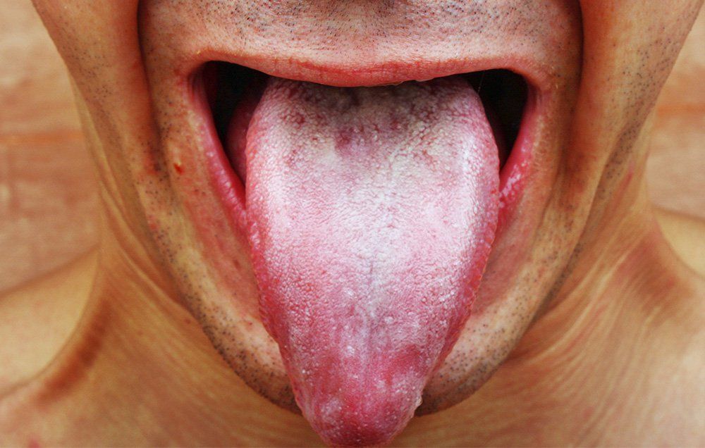 white painful bump on tongue