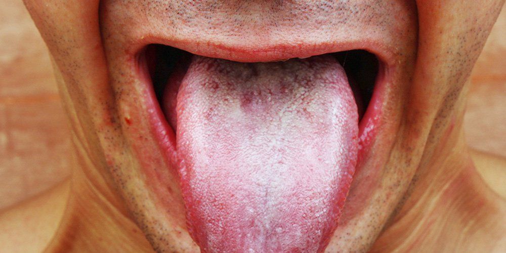 tongue infection yeast symptoms oral causes candidiasis film thrush should