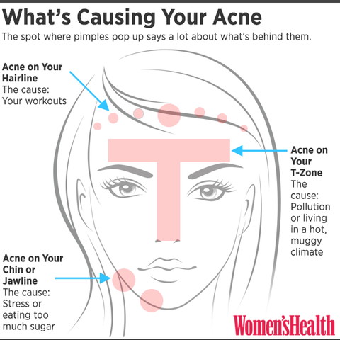 You Can Tell What's Causing Your Acne By Where You Break Out