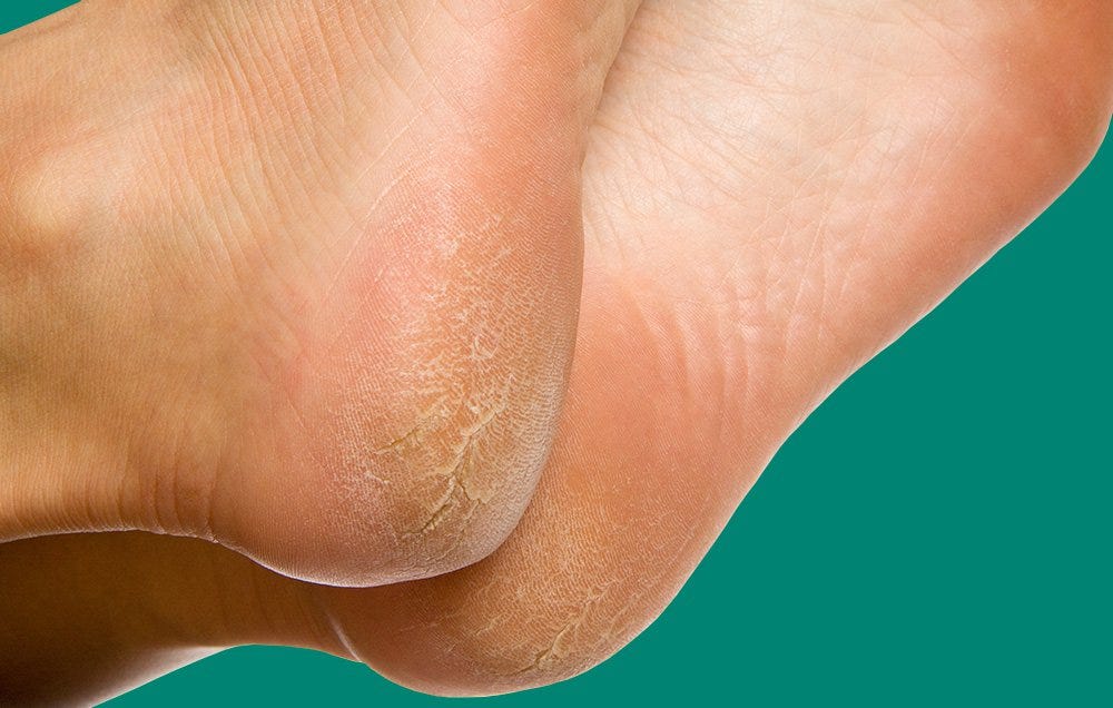 why-are-my-feet-peeling-women-s-health