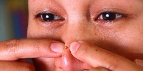 woman squeezing blackheads on nose
