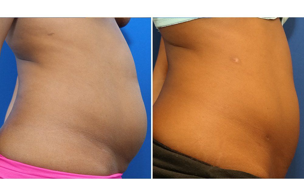 Las Vegas Laser Lipo