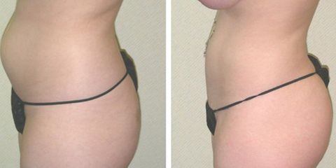 butt lift fat transfer before and after