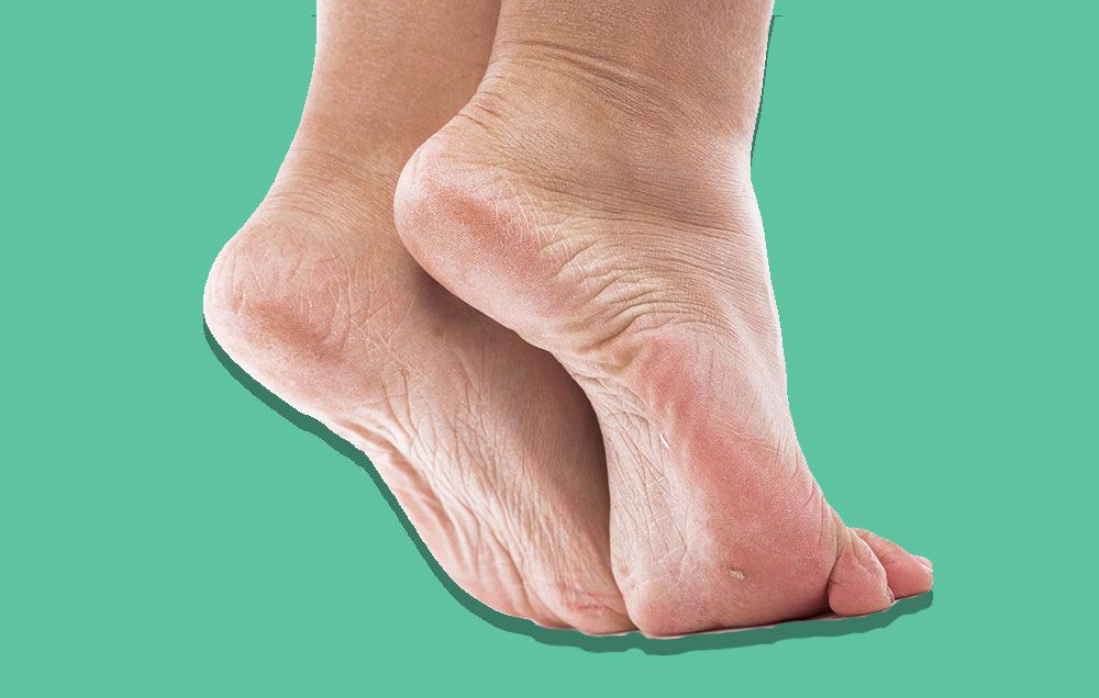 How to Get Rid of Calluses On Your Feet 