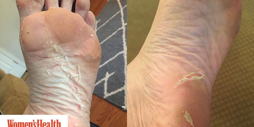 Baby Foot Peel I Tried It And Here S What Happened Women S Health