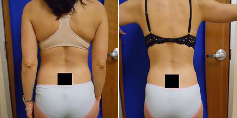 Do Laser Treatments For Weight Loss Actually Work?