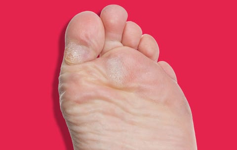 Callus Removal YouTube Channel | Women's Health