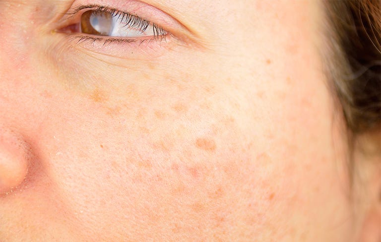 How To Get Rid Of Dark Spots, According To Dermatologists - Best Dark