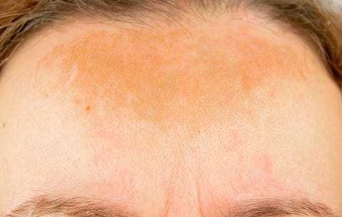 What Is Hyperpigmentation Women S Health