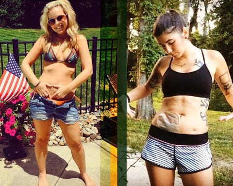 One Woman S Colostomy Bag Swimsuit Photo Has Kickstarted An Image