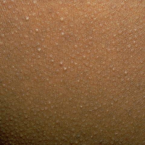 13 Face Bumps You Get Under Your Skin And How To Get Rid Of Them