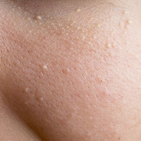 13 Face Bumps You Get Under Your Skin And How To Get Rid Of Them