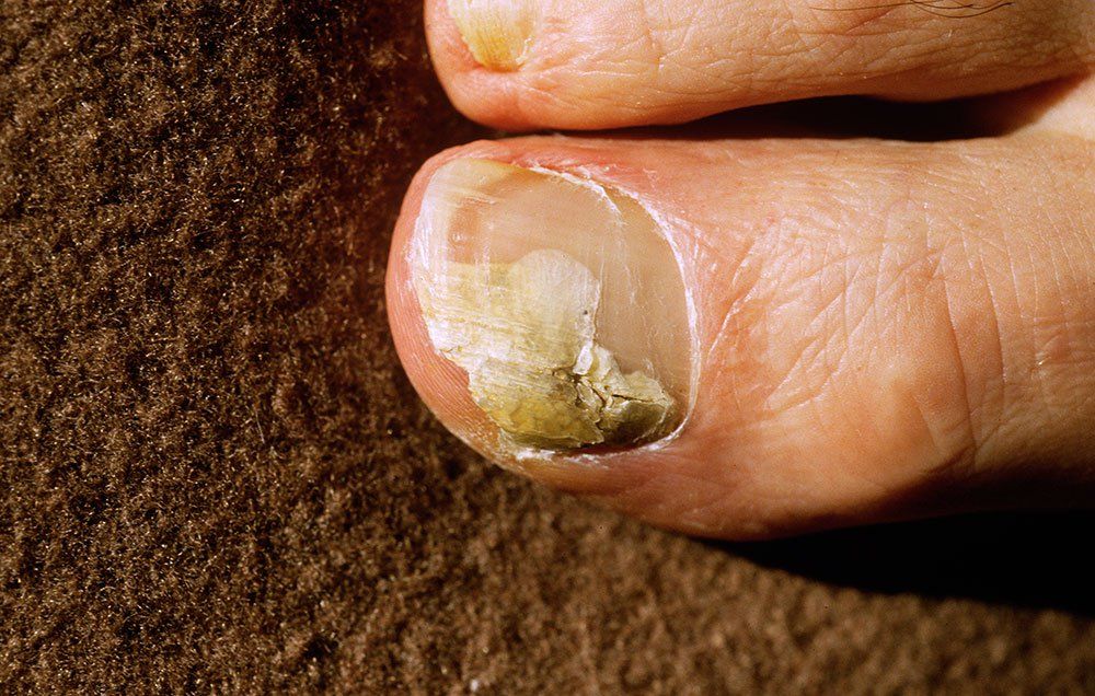 treatment of nail fungus at home