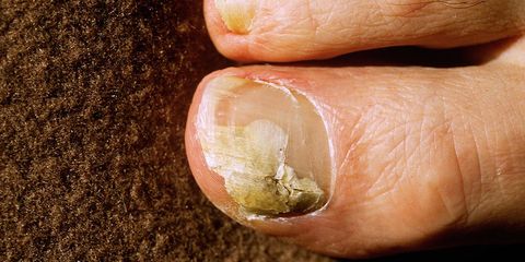 6 Natural Ways To Deal With Nail Fungus Women S Health