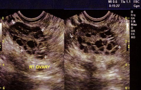 polycystic ovary symptoms