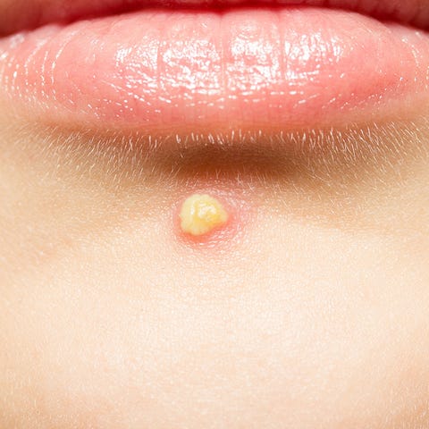 8 Common Bumps On Your Skin You Should Never Pop